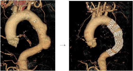 胸部大動脈瘤の説明図です